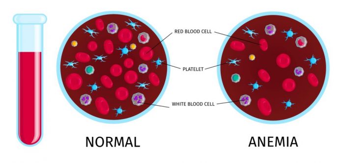 L’anémie : Modes de préventions pour maintenir une santé globale