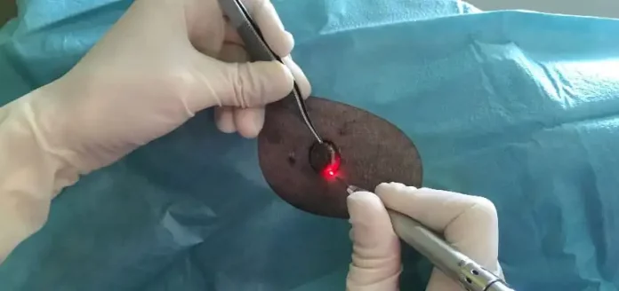 Chirurgie au laser: L’Hôpital Laquintinie prend de l’avance