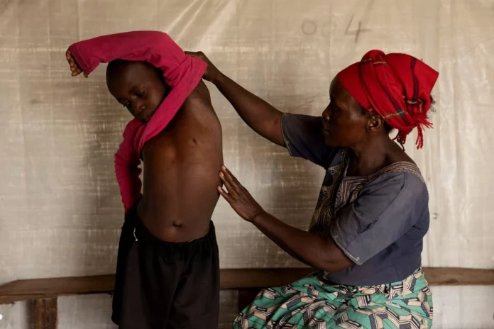 En Afrique, la résurgence de cas de Mpox inquiète