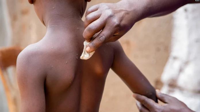 Au Burundi, un tiers des malades du mpox a moins de 5 ans, selon l’ONU