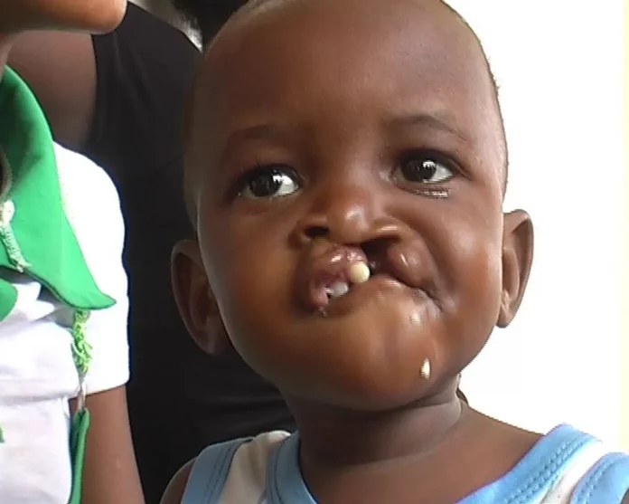Bec de lièvre : Ça se soigne à Douala