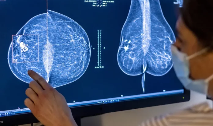 Cancer du sein: l’IA améliore le dépistage humain