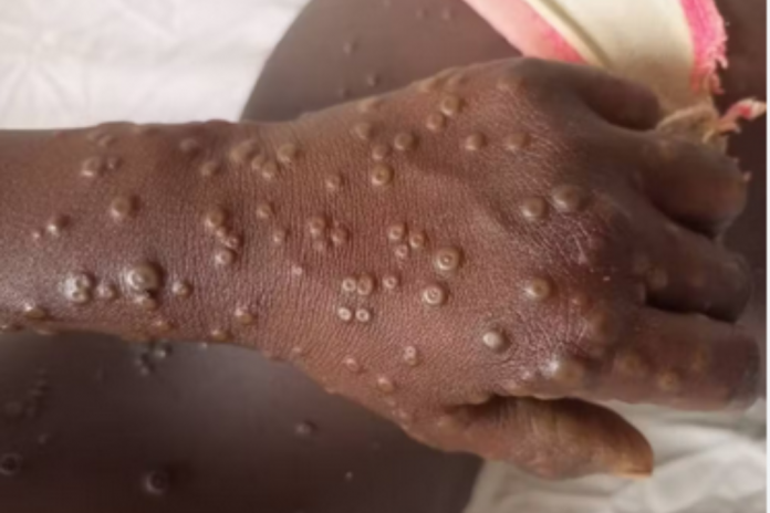 Littoral : campagne de vaccination contre la Variole du singe